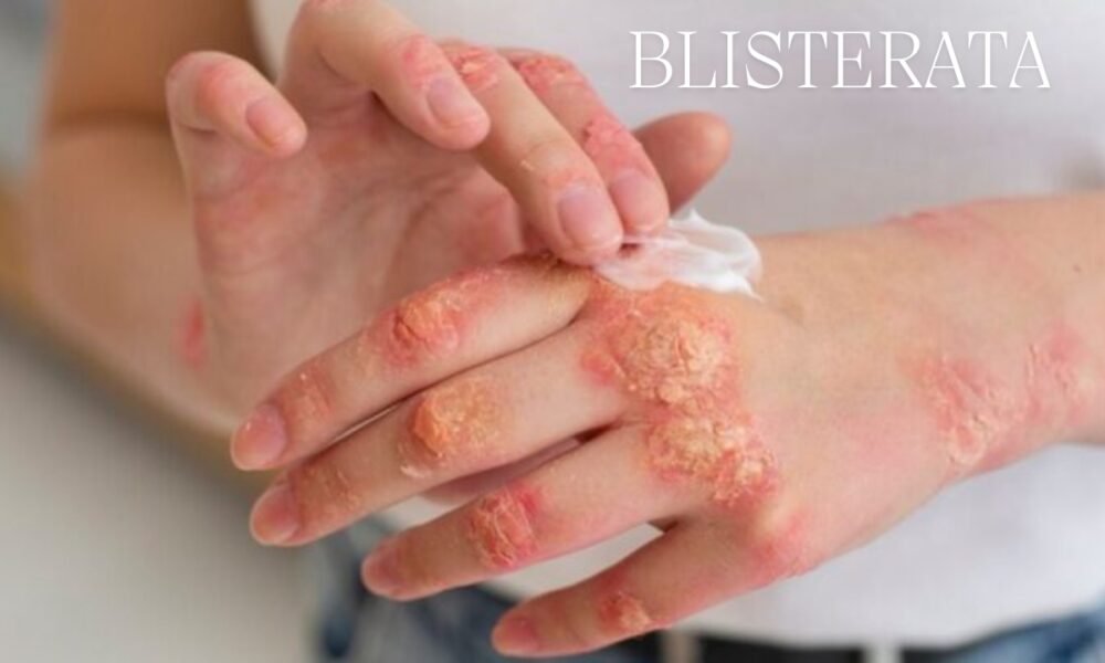 Blisterata