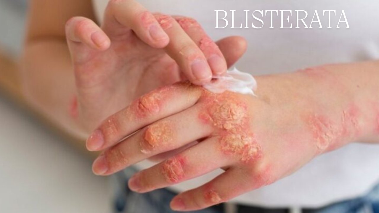 Blisterata